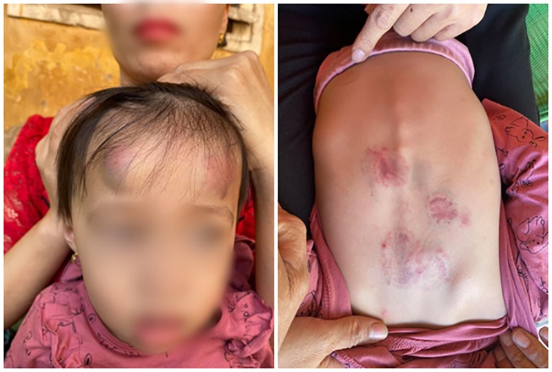 Vụ bé gái 22 tháng tuổi ở Bắc Giang bị đánh đập dã man: Người quản lý phải có trách nhiệm bồi thường