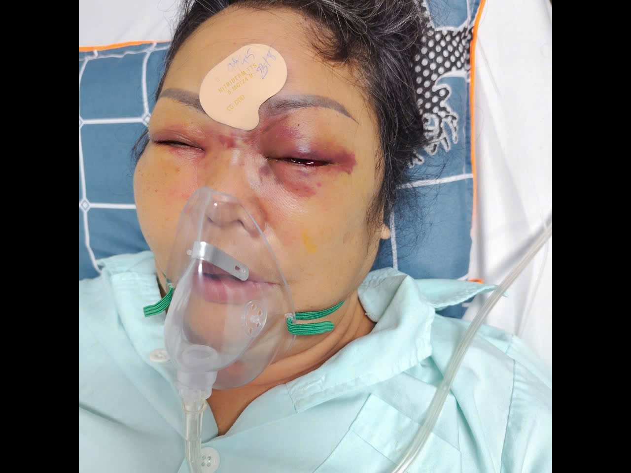 Nâng mũi cải vận nhận lại nỗi đau (bài 4): Tổn thương 41% cơ thể, nạn nhân tiêm filler ở Pusan nhận 250 triệu đồng bồi thường